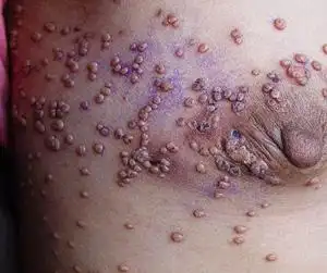 器脸背部皮肤皮肤全身扩散实拍手抄图身上长小红点与艾滋病有关系吗?