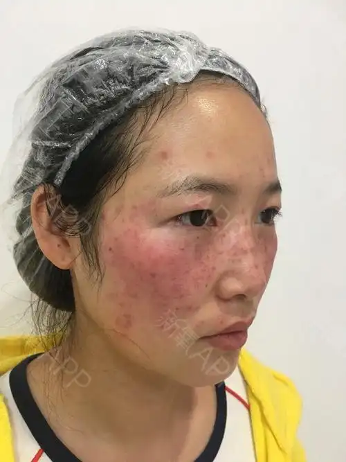 【皮秒激光第0天】【十二星座小雀幸祛斑0天】雀斑是_圈子-新氧美容