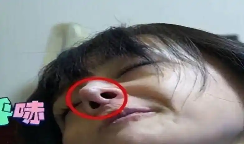 为什么整鼻子鼻翼