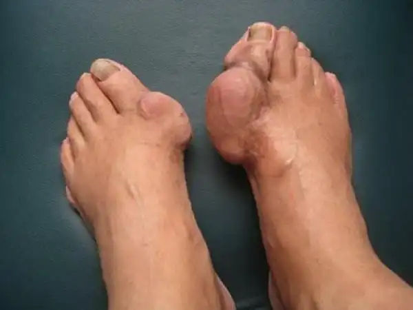 痛风特效断根秘方,治一个好一个,转发一次,救人无数,功德无量!