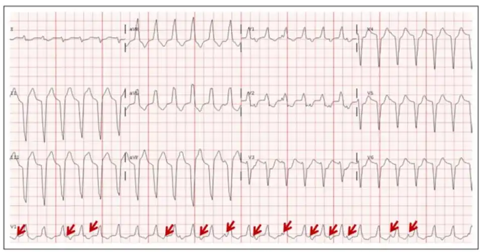 这种心电图要警惕地高辛中毒
