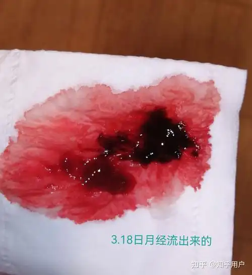 药流后有3.5cm残留,保守治疗近80天,清楚残留