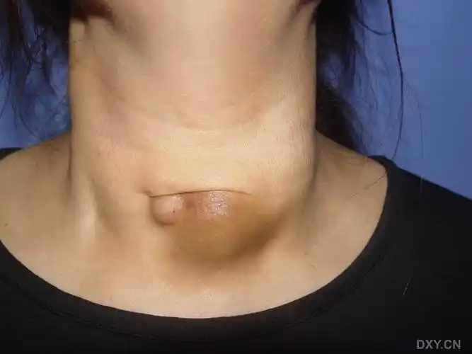 【病例讨论】大家看看这个甲状腺肿瘤的病人资料,还能手术吗?