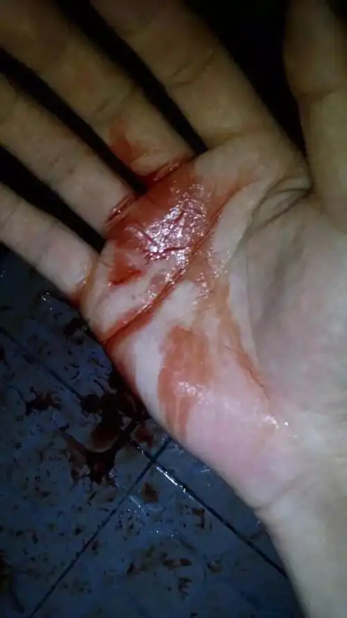 iphone6屏幕又碎了,还把手划破了