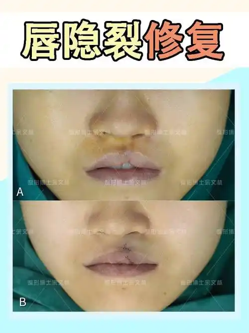 案例分析一个唇隐裂的小姐姐手术后唇部恢复正常