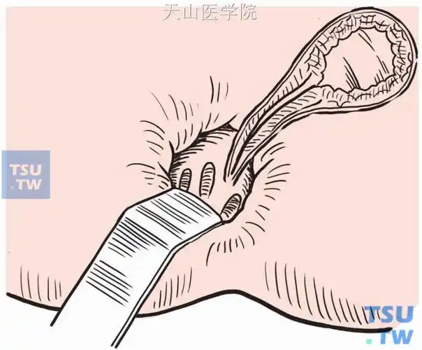 【图】肛瘘瘘管一期切开术 - 外科手术学 - 天山医学院