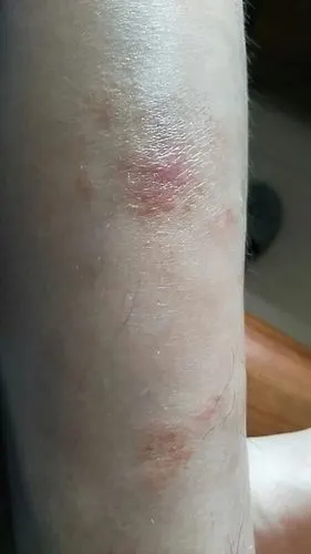 小腿有红斑块,有时好痒,用了治藓的和湿疹的乳膏都没用,经常复发