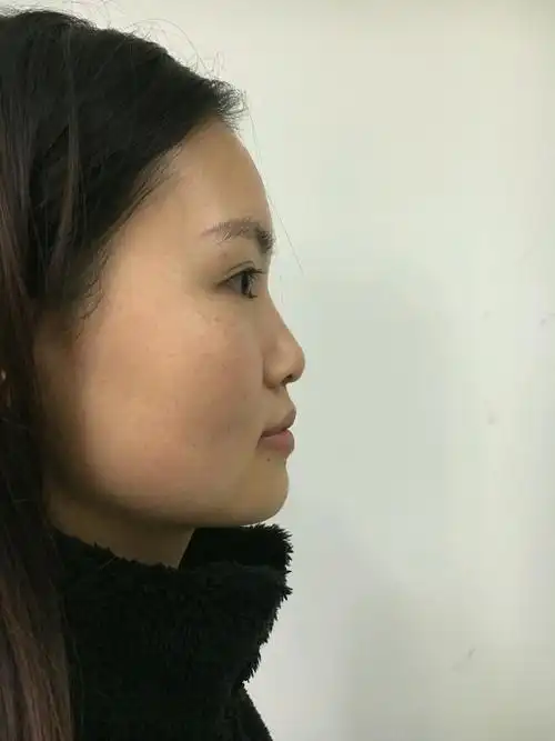 天生塌鼻头,之前想做但是因为怕一直没有勇气,不得不_圈子-新氧美容