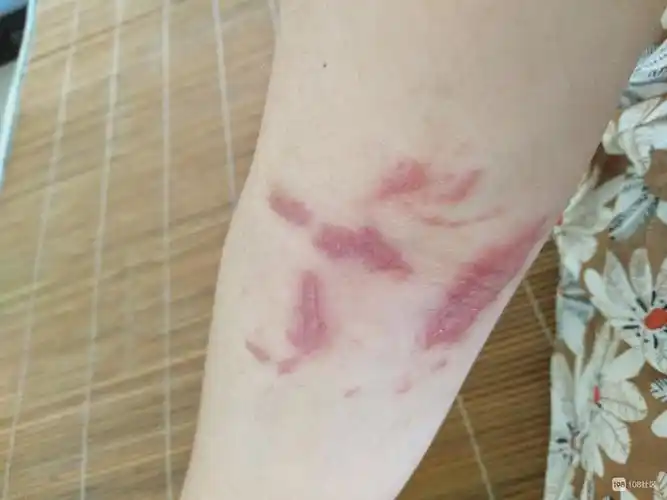 红肿_畅说景德镇_景德镇108生活社区