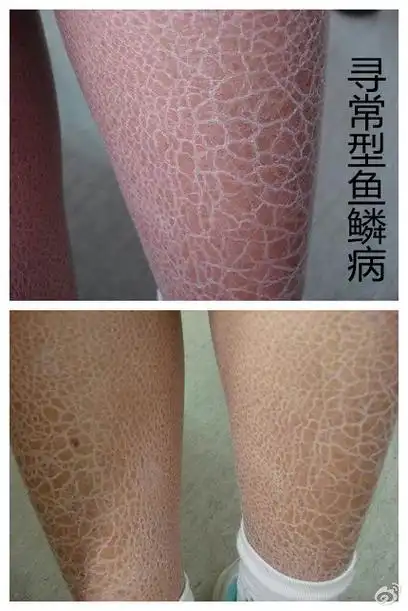 干皮病的介绍