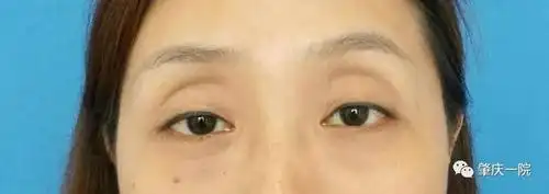术前(正面)上眼眶凹陷,原双眼皮消失,眼球外凸,黑眼圈