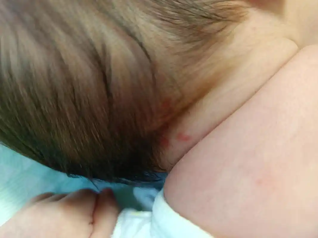 偶然发现七七后颈有几块红斑,叫新生儿红斑,关于它还