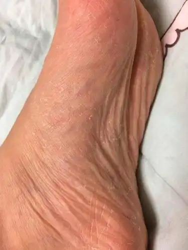 脚痒-系统性红斑狼疮康复圈-觅健