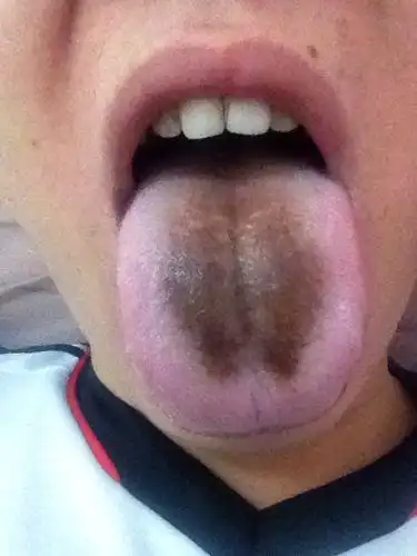 舌头发黑是怎么回事,疾病原因不可大意! – 时尚女人网