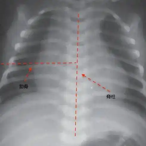 宝宝肋骨外翻就是佝偻病?