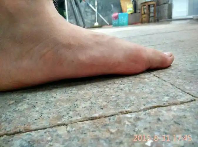 参军体检是说我是扁平足 ,但是x射线上不是,影响参军吗?