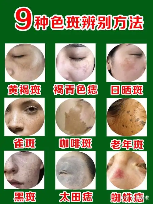 祛斑常识9种常见色斑辨别方法