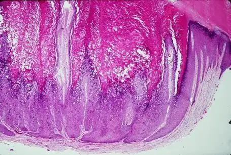 外阴鳞状上皮细胞增生