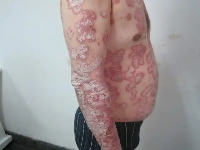 牛皮癣能治好吗