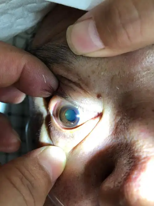 脑梗死溶栓后出血,双侧瞳孔散大,呼吸衰竭,系列救治措施,病人命不该绝