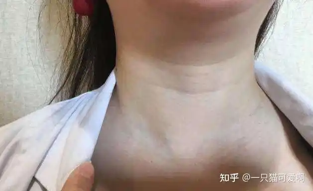 高中生感染hpv,脖子长满"菜花",提醒:这2样东西,千万别公用 - 知乎