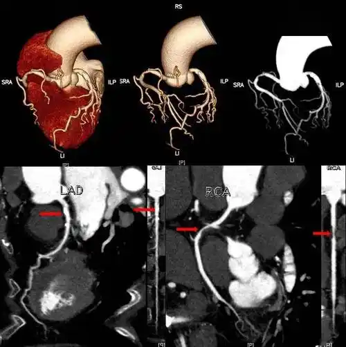 女,78岁,术前检查,左前降支近段管壁混合斑块,管腔中度狭窄,右侧冠状