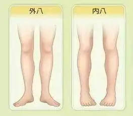 ①外八字走路这种走路姿势,时间久了容易养成xo型腿,看起来就会有小腿
