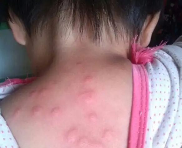 为什么小孩也会患上荨麻疹?可能与这些原因相关,别忽视