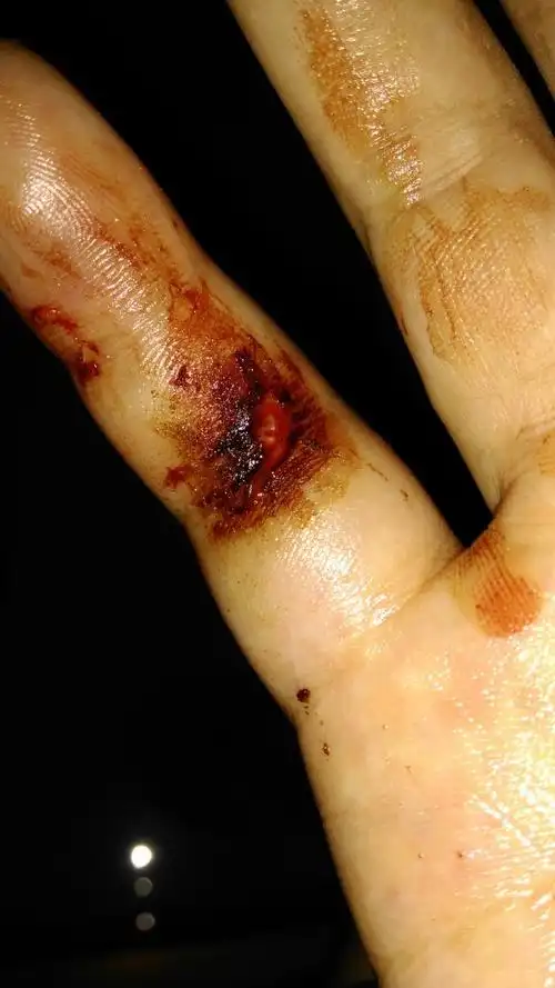 我昨晚摔跤手指错位,还有皮外伤,然后我买了药涂进了伤口,有图片,大家