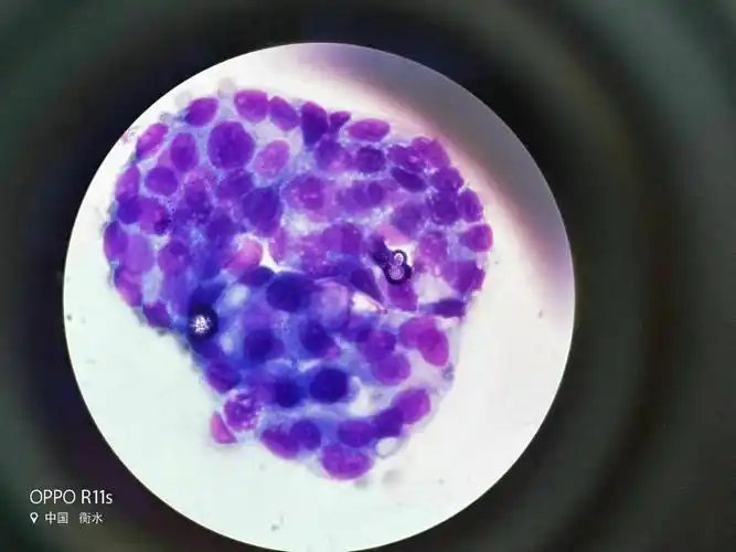 离心,涂片,瑞氏染色后可见融合在一起的成团癌细胞.