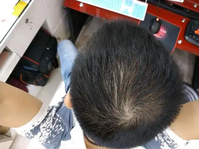 请问医生快28岁这个月发现头顶头发突然稀少了很多怎么办