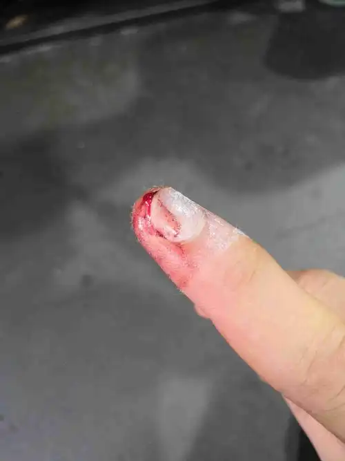 手指头压伤