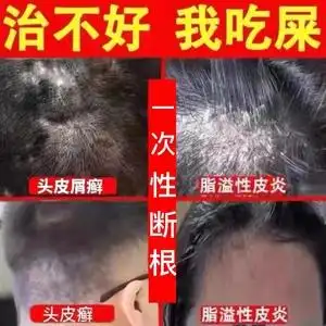 脂溢性皮炎去根除头皮癣头癣头皮屑头部面部外用软膏专用药膏