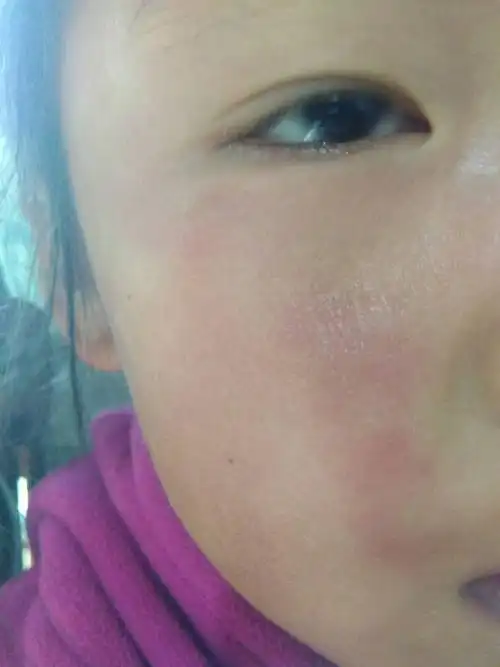 5岁儿童脸部红斑,不固定地方,睡一觉就消失了,别的地方又有了!