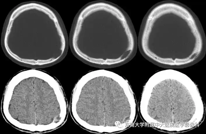 病例颅骨嗜酸性肉芽肿1例ct及mr–影像ppt
