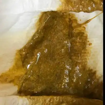 女宝6个半月左右,已经拉了十天左右这样的便便,这是