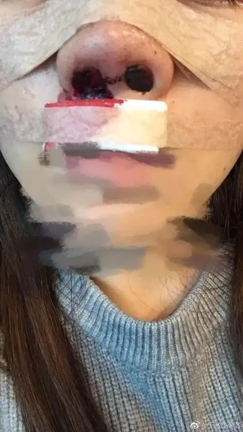 你鼻子都整了拍裂怎么了