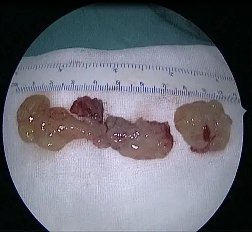 鼻腔鼻窦手术是否会引起鼻整形的植入物假体感染与排异(图)_隆鼻_疾病
