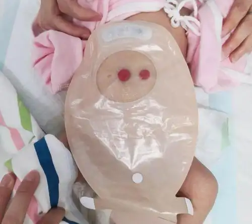 解放军总医院第七医学中心儿童基础外科第一届造口宝宝联谊会