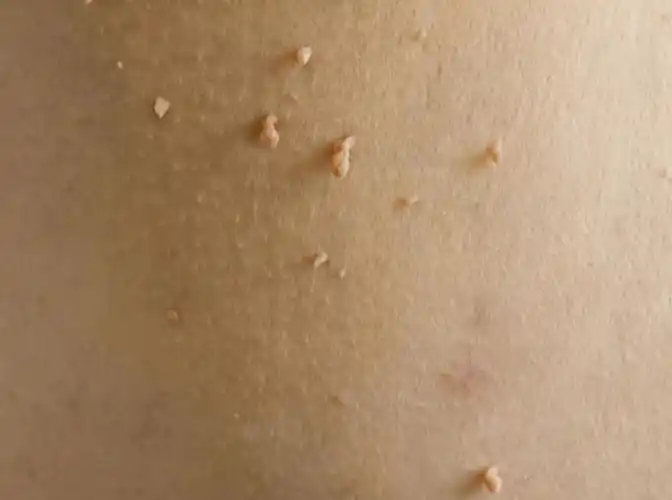 粒",表面光滑,不要随意用手去抠,这很可能是感染hpv病毒,引发的丝状疣