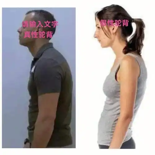 真假驼背你是真的驼背吗