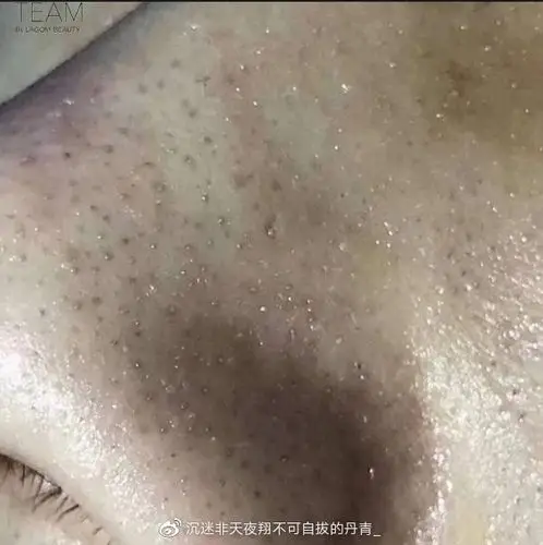 我的黑头/角栓不知不觉间消失了