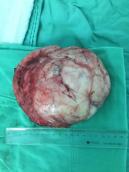 17cm乳腺巨大叶状肿瘤 - 好大夫在线