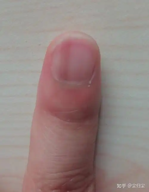 左手大拇指指甲有一条淡褐色竖线好几年了微量元素也正常为什么啊