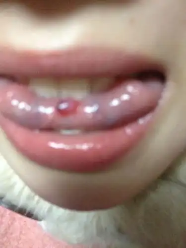 舌头下面起一个小水泡,请问是怎么回事?