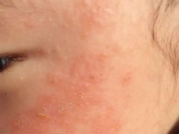 婴儿湿疹那哺乳期妈妈有哪些不能吃呢