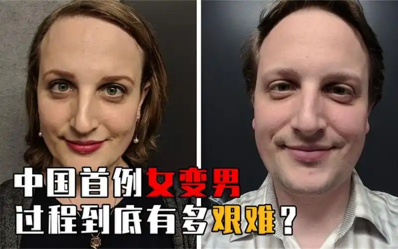 揭秘女变男全过程,17年前中国首例女变男变性人,后来怎么样了?