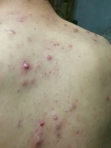 背后和前胸长了一个个小红包,久了就会发浓!