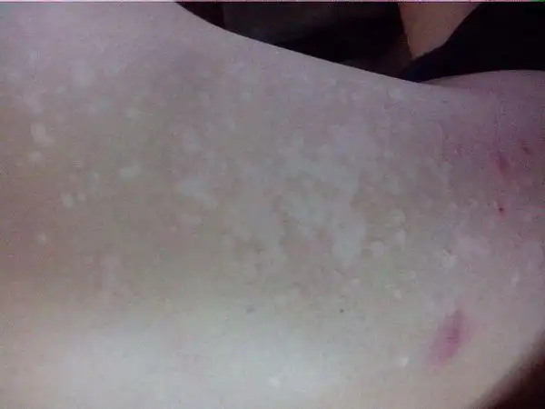 我背上长了些白色的斑点,开始只有一小点过了几个