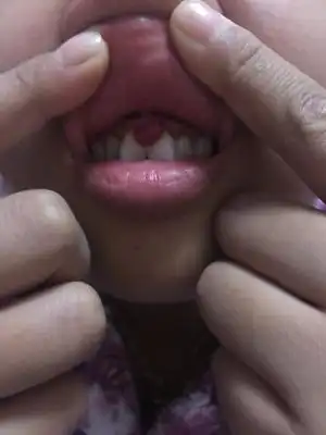 如果是牙龈瘤,是不是一定要拔牙才可以治?该怎麼办啊?